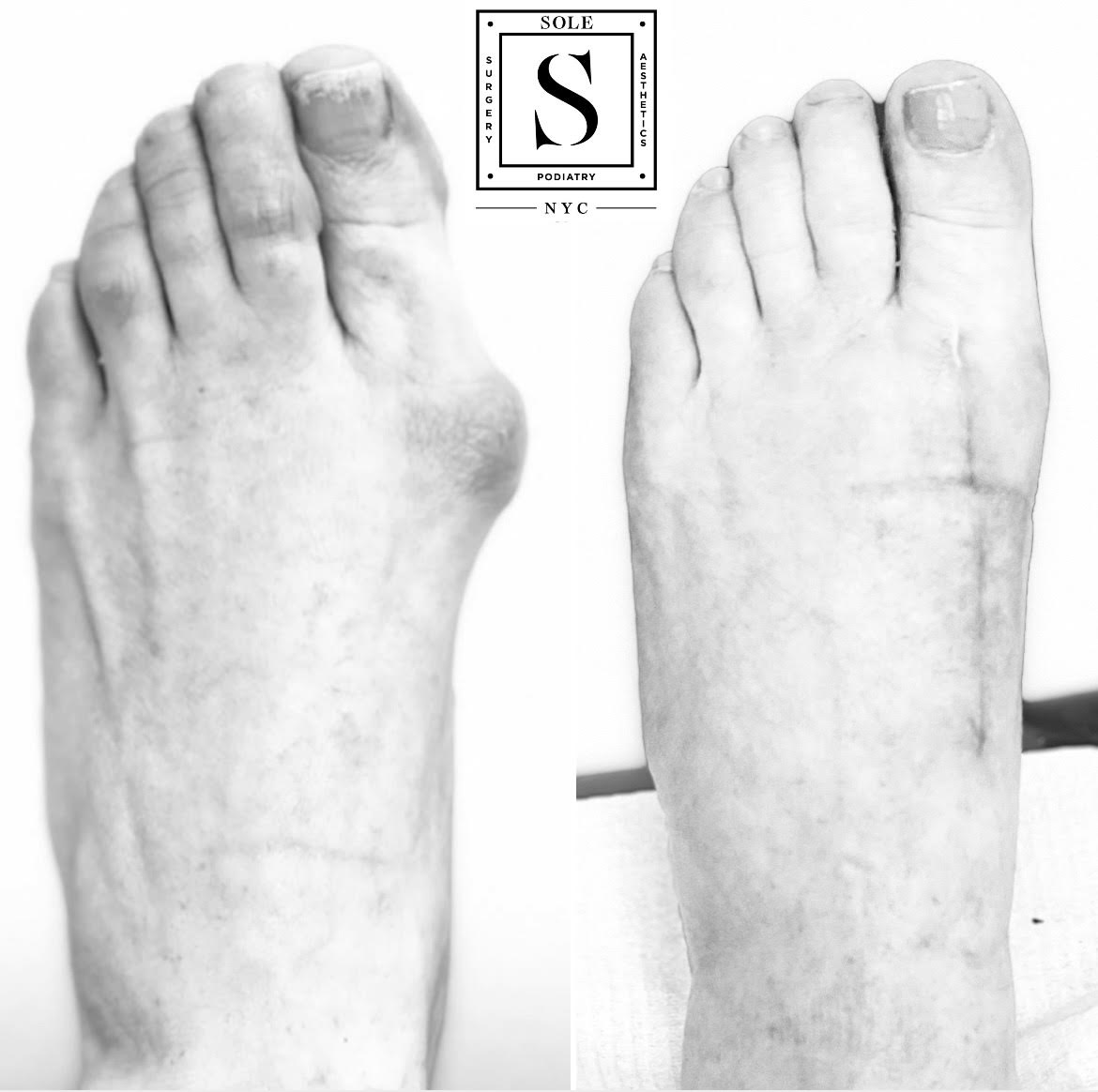 Before and After Surgery Sole Podiatry NYC